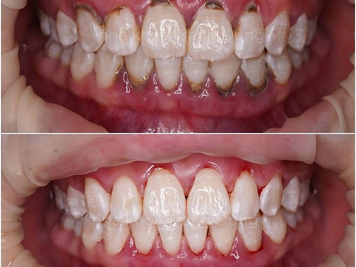 Tẩy trắng răng tại Nha khoa Trang Dung