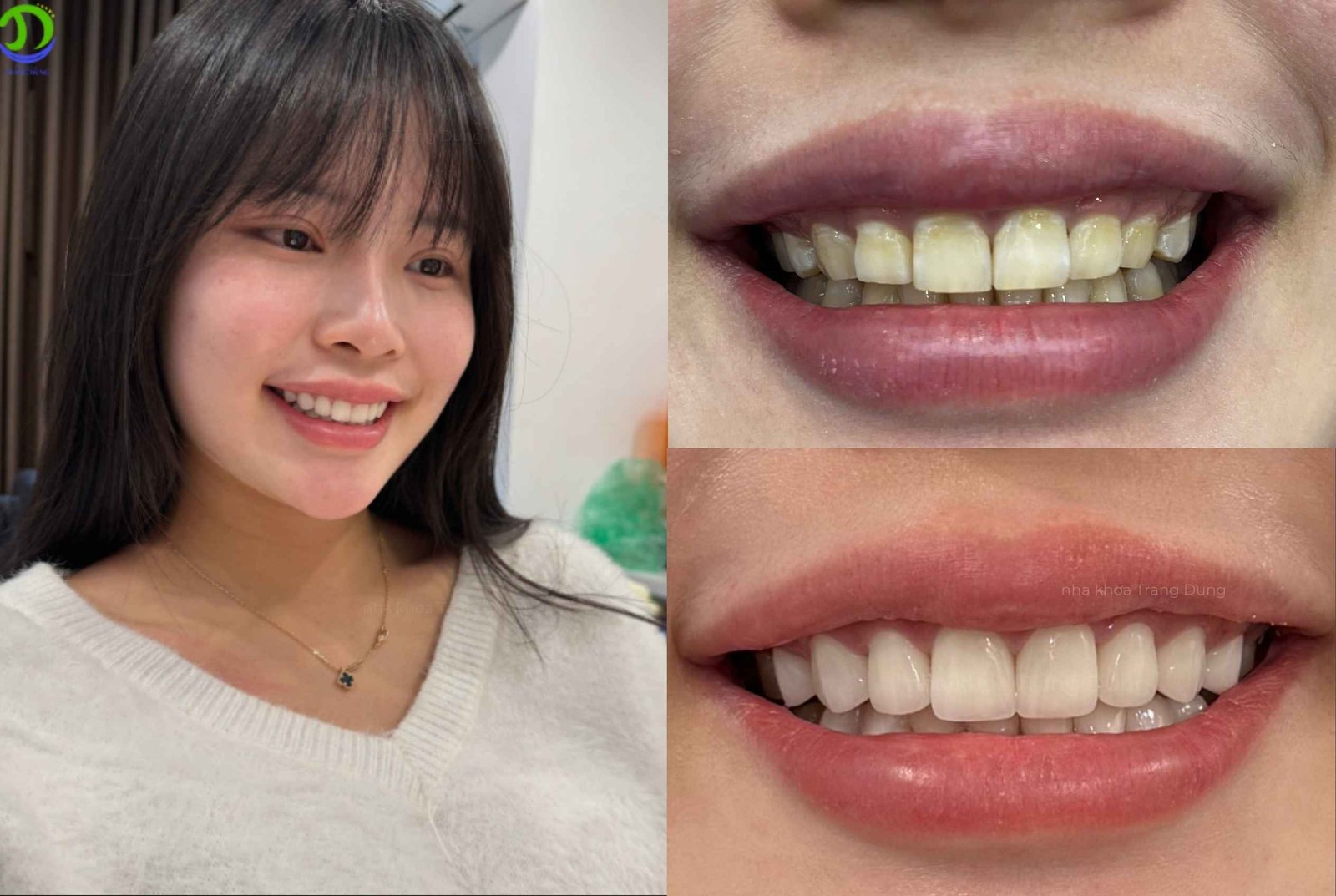 Thẩm mỹ răng sứ toàn hàm tại Nha khoa Trang Dung
