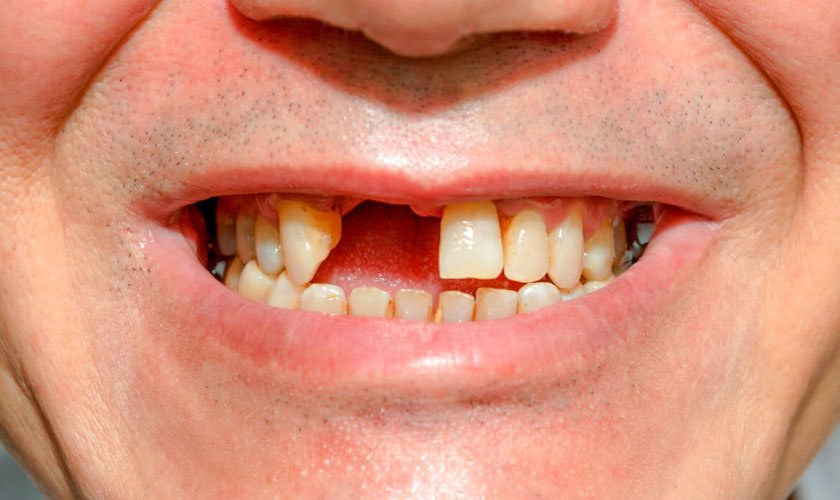 Nằm mơ thấy gãy răng​