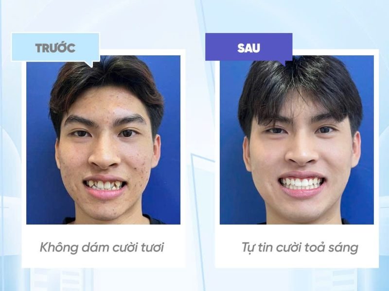 khach-hang-phac-do-dieu-tri-nieng-rang-nguyen-minh-thanh (4) Niềng răng uy tín Hà Nội